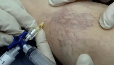 skleroterapie pro křečové žíly