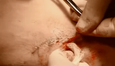 typy operací k odstranění křečových žil